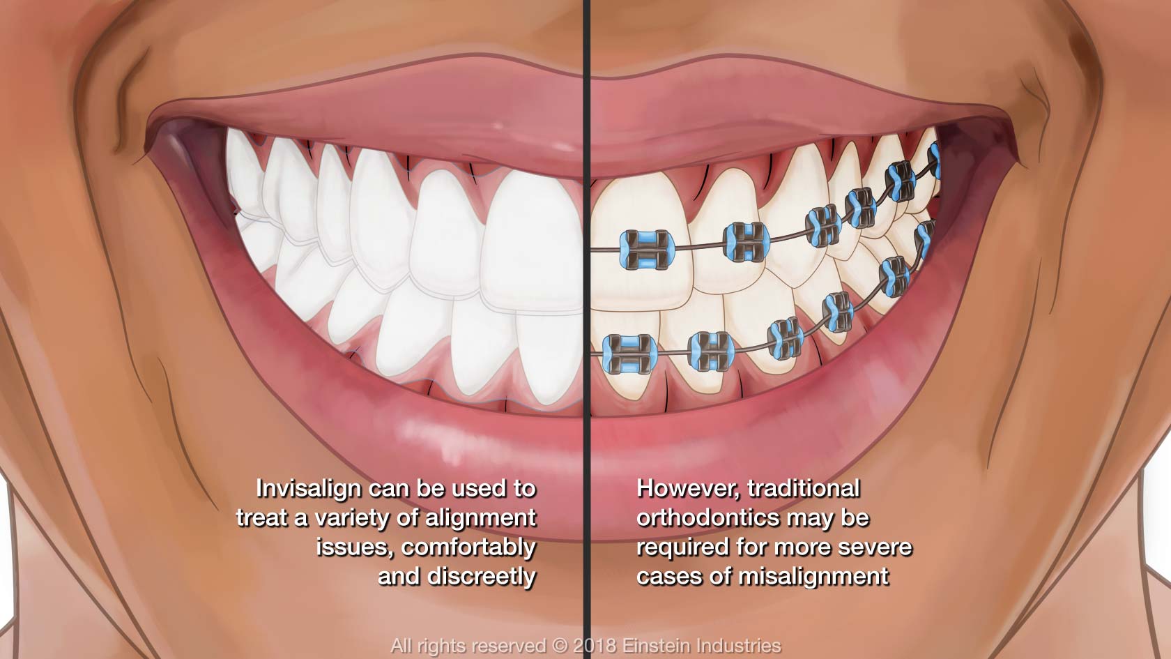 Invisalign Advantages vs Traditional Braces. What's the Better Option? -  Alicia Dental