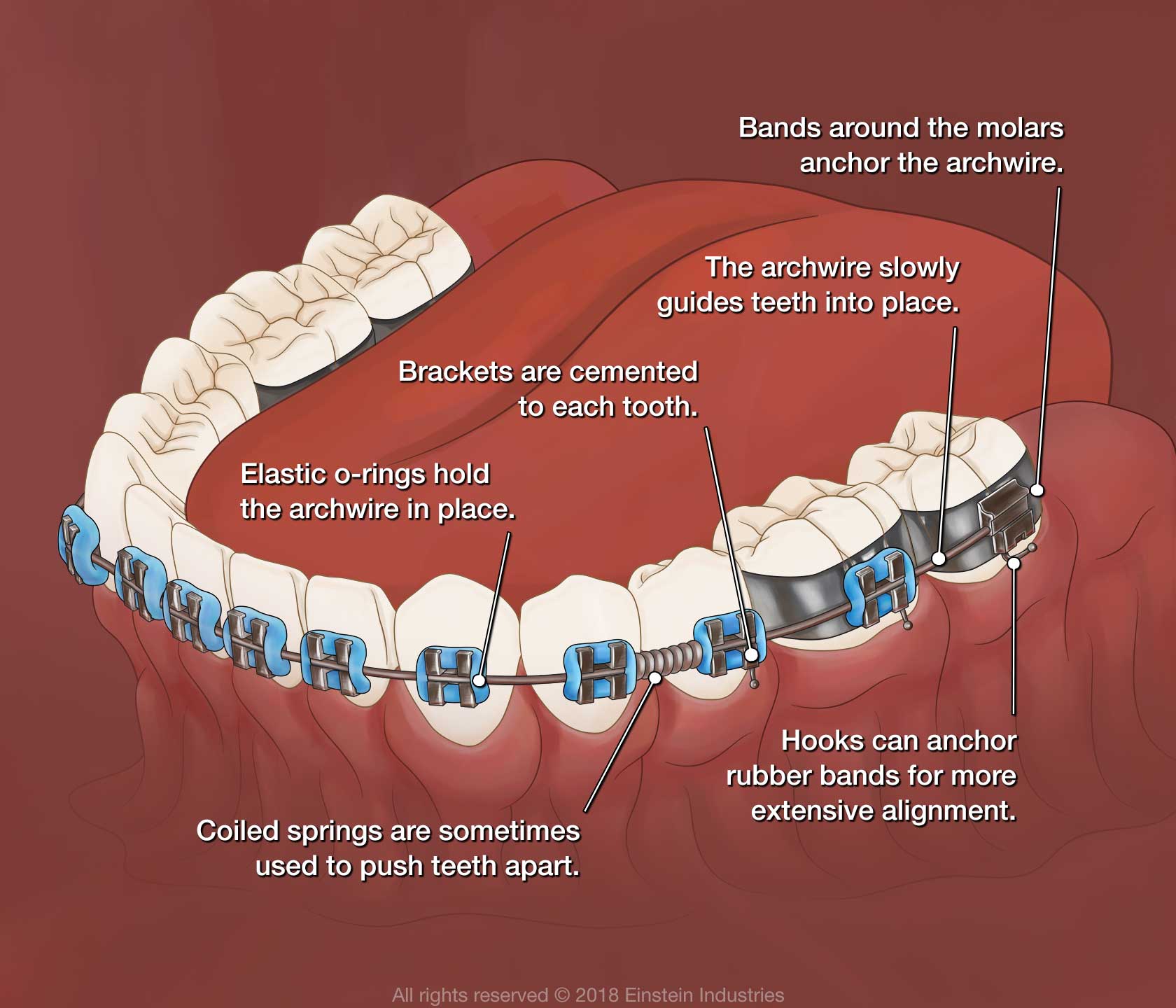 What's On My Teeth? - Girdwood Orthodontics