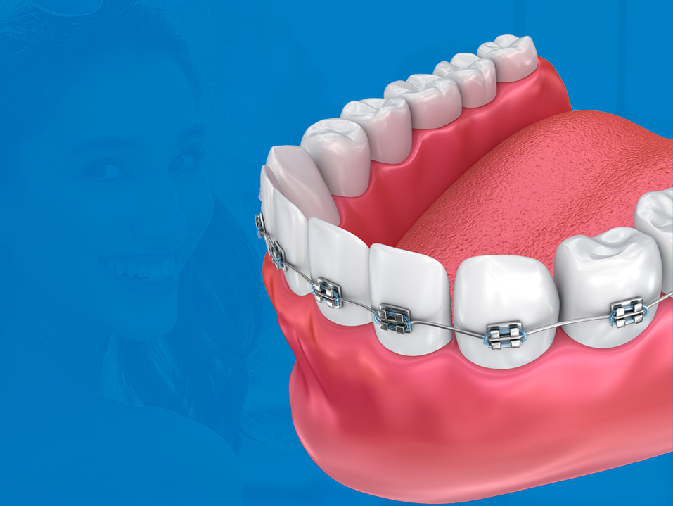 Why Do Orthodontists Prescribe Braces for Impacted Teeth?