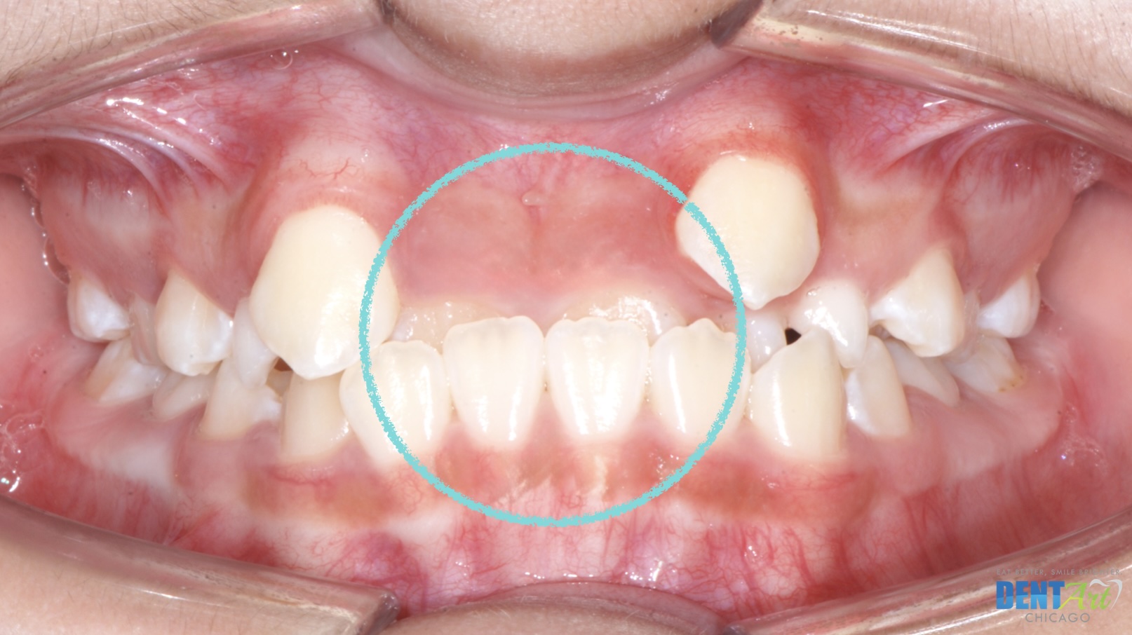 Anterior Cross bite