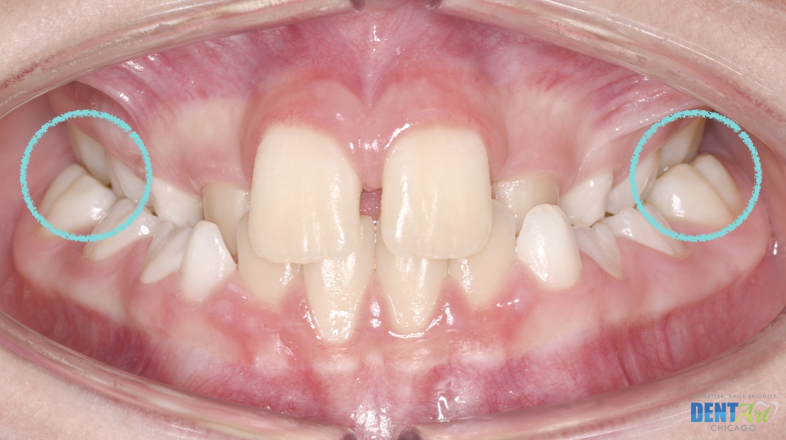 Bilateral Crossbite