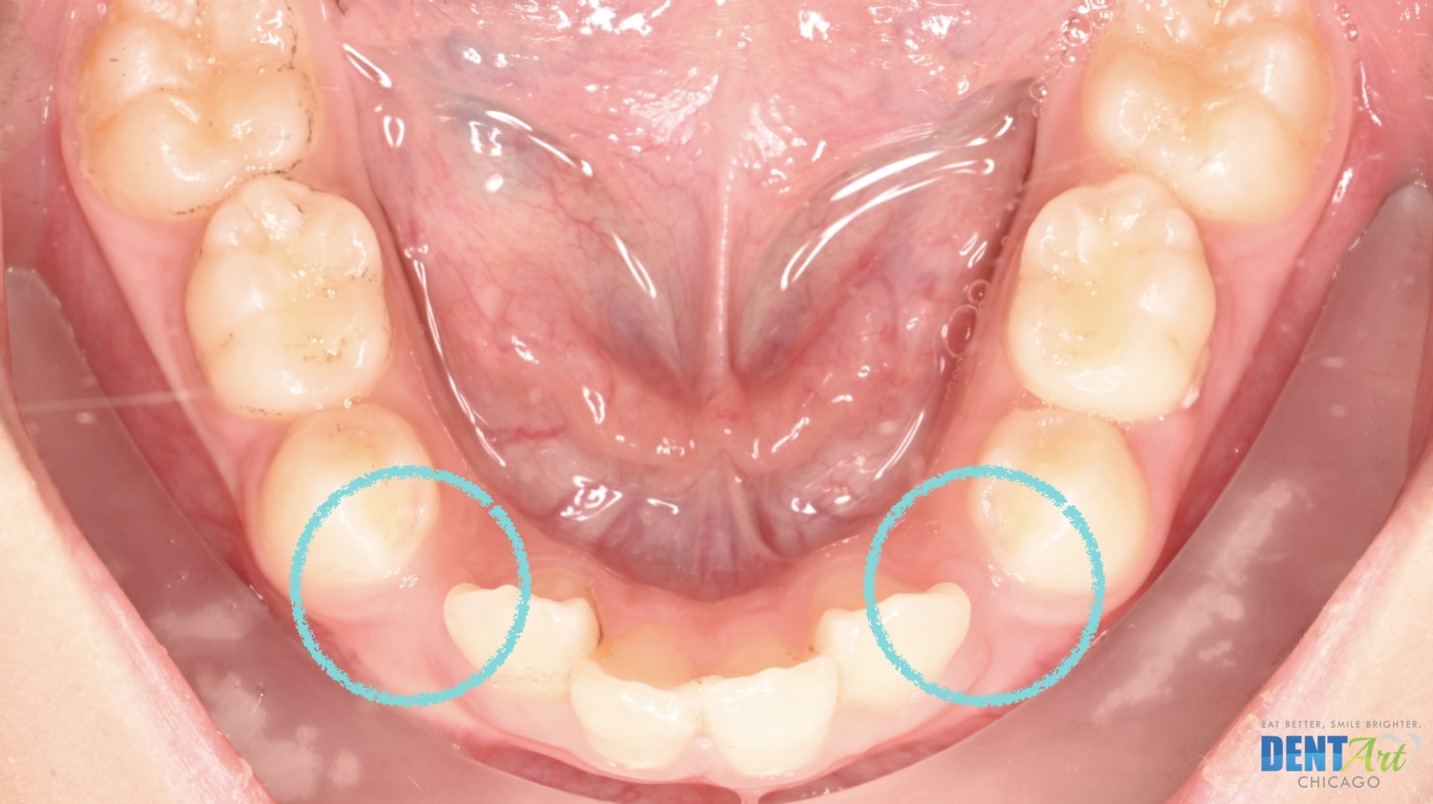 Premature Primary Teeth Loss