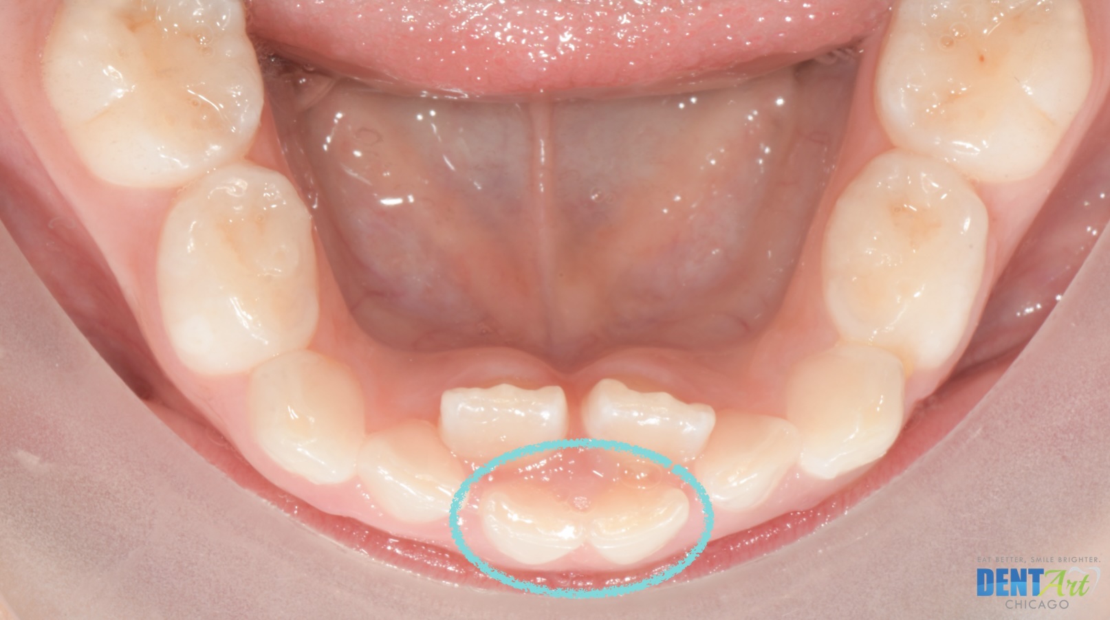 Retained Primary Teeth