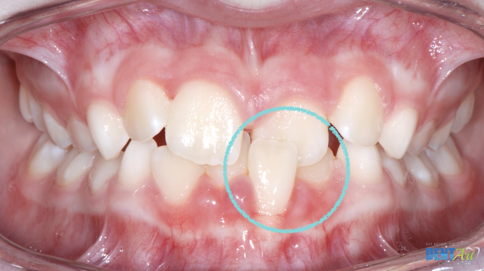 Single tooth cross bite