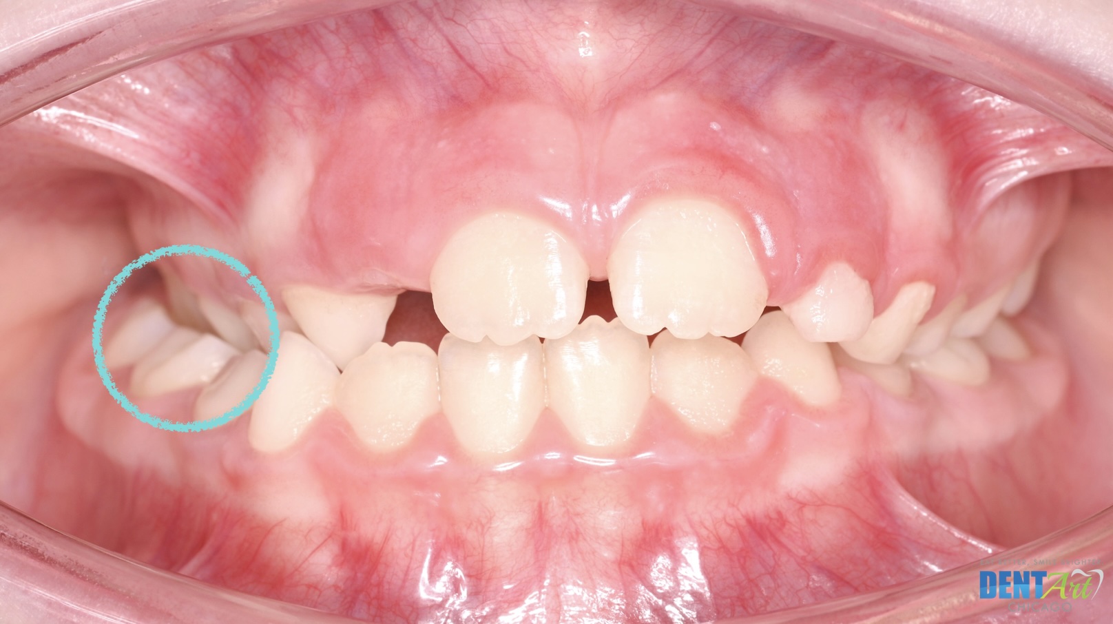 Unilateral Crossbite