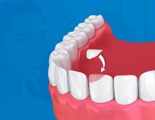 Dental Bonding: Before and After Care Instructions